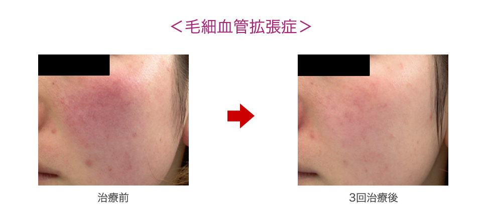 毛細血管拡張症