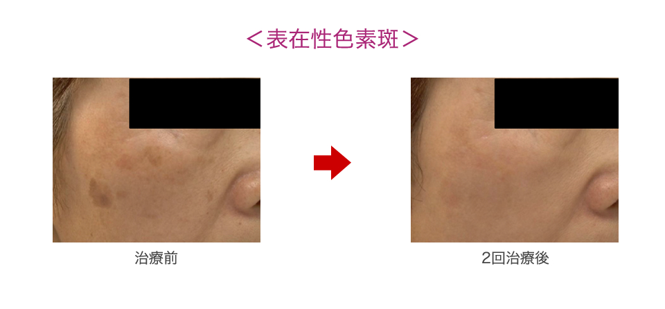 表在性色素斑