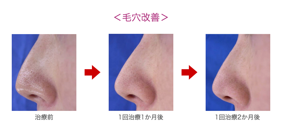 毛穴改善